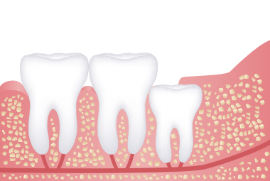 간단 수술 발치