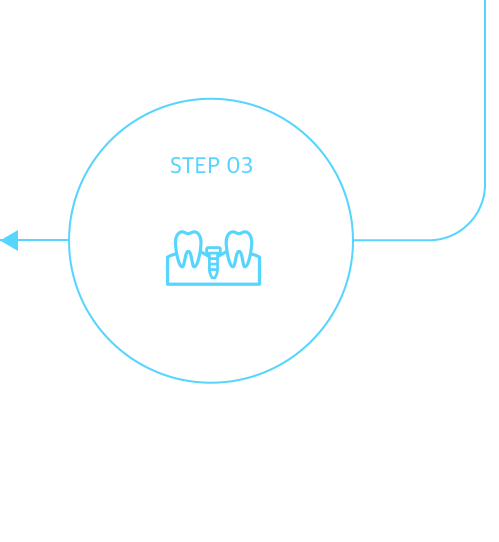 임플란트 식립(1차 수술)
