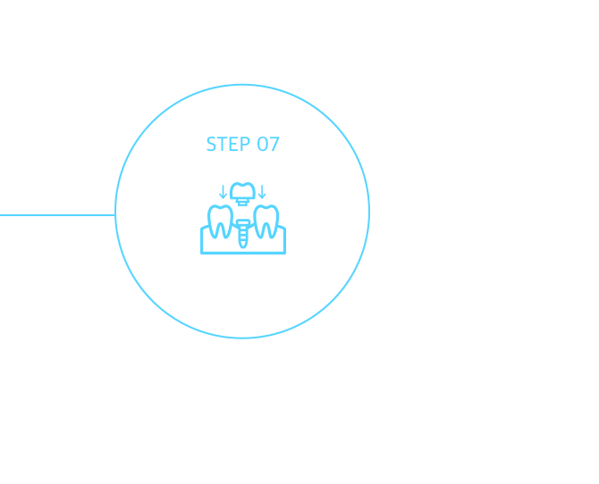 2차 수술 or 임플란트 보철물 제작