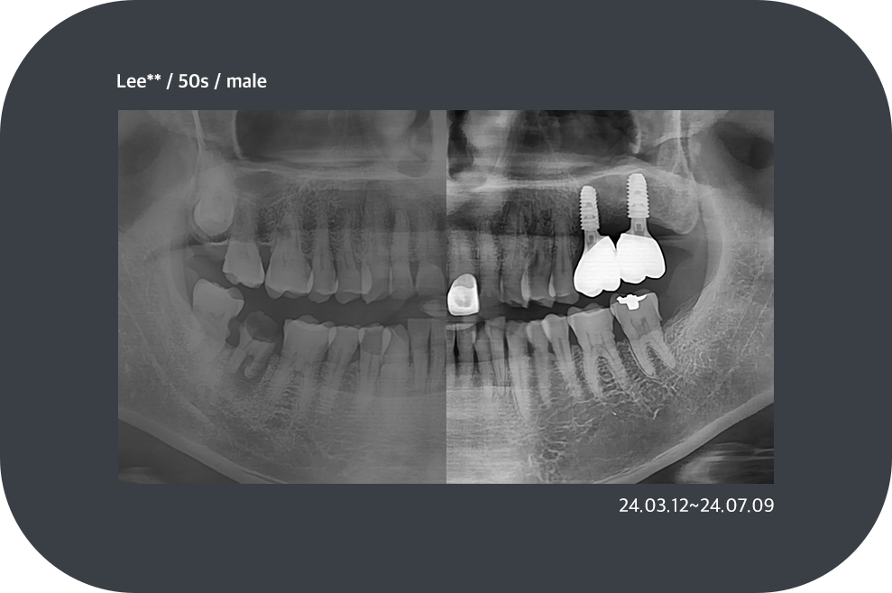 implant_case01