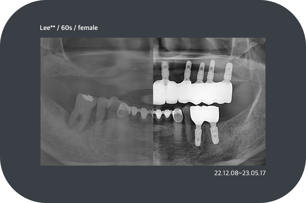 implant_case03