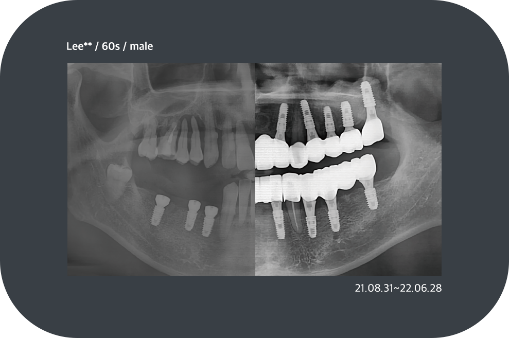 implant_case08
