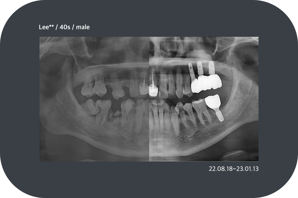 implant_case14