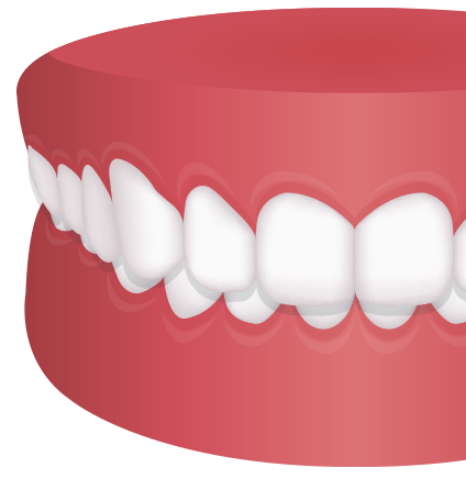 과개교합 치아모형